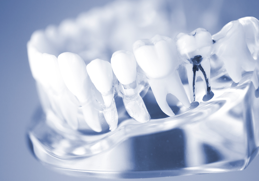 根管治療（歯内療法）